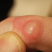 
	A myxoid cyst