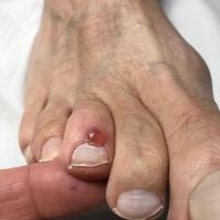 Myxoid cyst on the toe