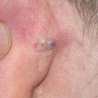 
	Giant comedone behind left ear