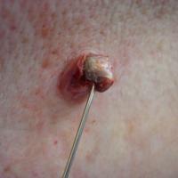
	Extraction of a giant comedone