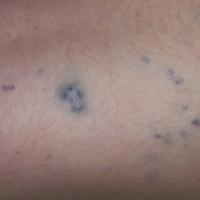 
	Multiple glomus tumours

	Copied with kind…