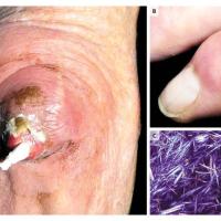 
	Gouty tophus on the elbow

	Compensated…