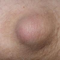 
	Gouty tophus - subcutaneous 