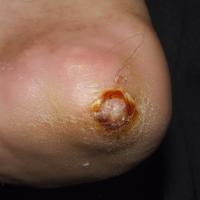 
	Gouty tophus on the heel

	Copied with kind…