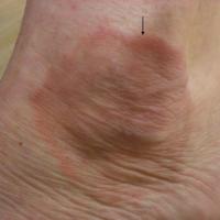 
	GA ankle

	Smooth raised edge (black arrow)