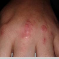 
	GA on the dorsal hand