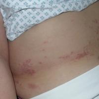 
	GA - many lesions