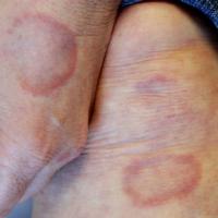 
	GA 

	All sites affected here are extensor…