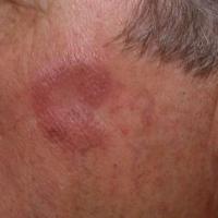 Granuloma faciale