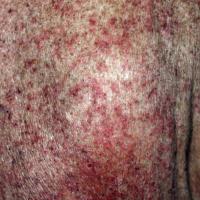 
	Grover's disease