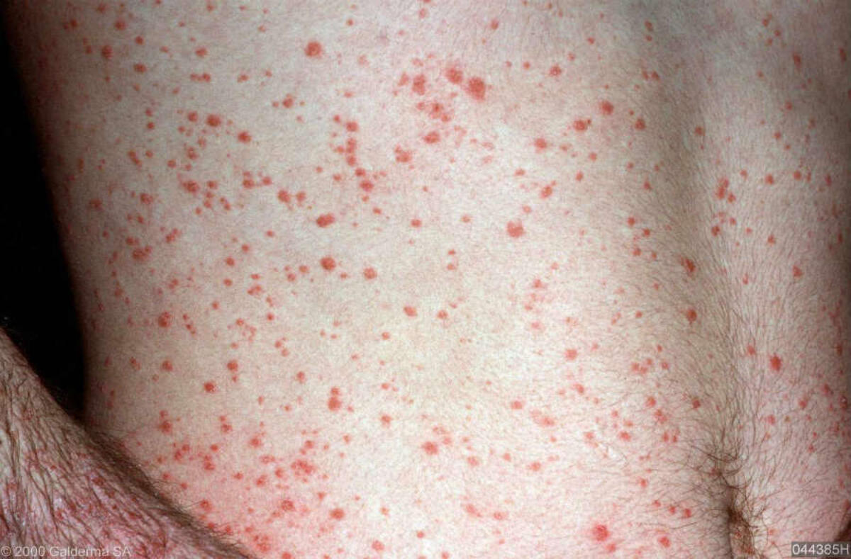 guttate psoriasis after strep