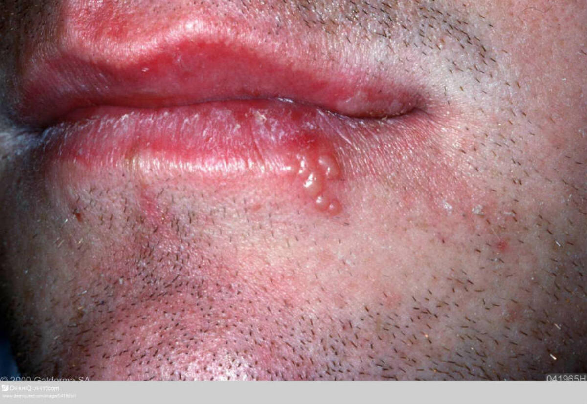 Type 2 herpes Can HSV2