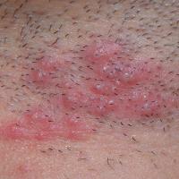 
	Herpes simplex on the neck

	Inoculation from…