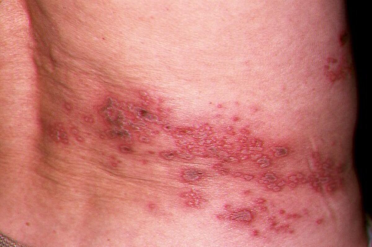 neurontin herpes zoster