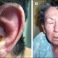 
	The Ramsay-Hunt syndrome
