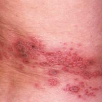 
	Herpes zoster - dermatomal…