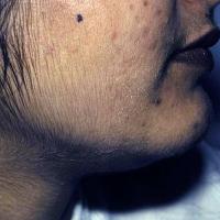 
	Hirsutism secondary to the Polycystic Ovarian…