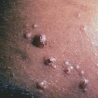 
	Cryptococcal infection associated with HIV