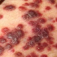 
	Kaposi's sarcoma associated with HIV