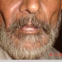 
	Lipoatrophy associated with antiretroviral drugs