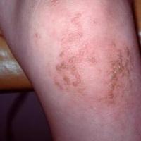 
	Ichthyosis hystrix - a milder form