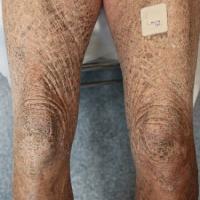 
	X-linked recessive ichthyosis

	Copied with…