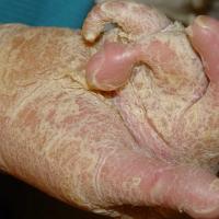 
	Epidermolytic ichthyosis