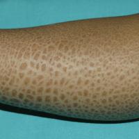 
	X-linked recessive ichthyosis

	Copied with…