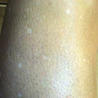
	Idiopathic guttate hypomelanosis