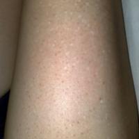 
	Idiopathic guttate hypomelanosis