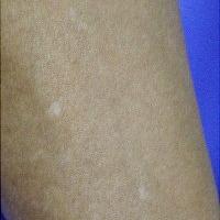 
	Idiopathic guttate hypomelanosis