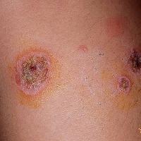 
	Bullous impetigo

	Copied with kind permission…