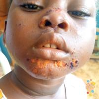 Impetigo&nbsp;
Copied with kind permission…