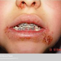 
	Impetigo