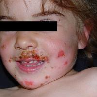 
	Impetigo

	Copied with kind permission from…