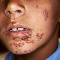 
	Impetigo

	Copied with kind permission from…
