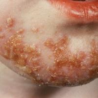 
	Impetigo