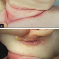
	Intertrigo on an infant's neck 