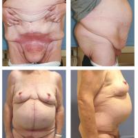 
	Intertrigo and obesity
