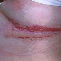 
	Intertrigo - very painful 