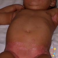 Intertrigo and candida
Copied with kind…