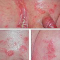 
	Intertrigo and streptococcal infection 