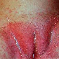 
	Intertrigo and candida

	Copied with kind…