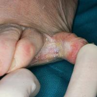 
	Intertrigo in the toe web 