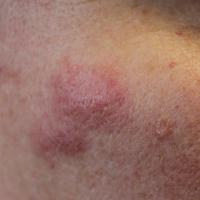 
	Jessner&rsquo;s lymphocytic infiltrate