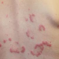 
	Jessner&rsquo;s lymphocytic infiltrate on the…