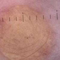 
	Dermoscopic appearance of figure 2