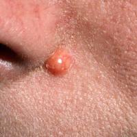 
	Juvenile xanthogranuloma - adult