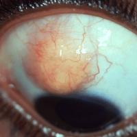 
	Juvenile xanthogranuloma of the eye

	Copied…