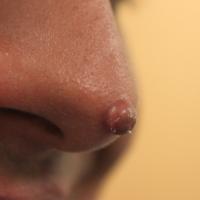 
	Juvenile xanthogranuloma - teenager